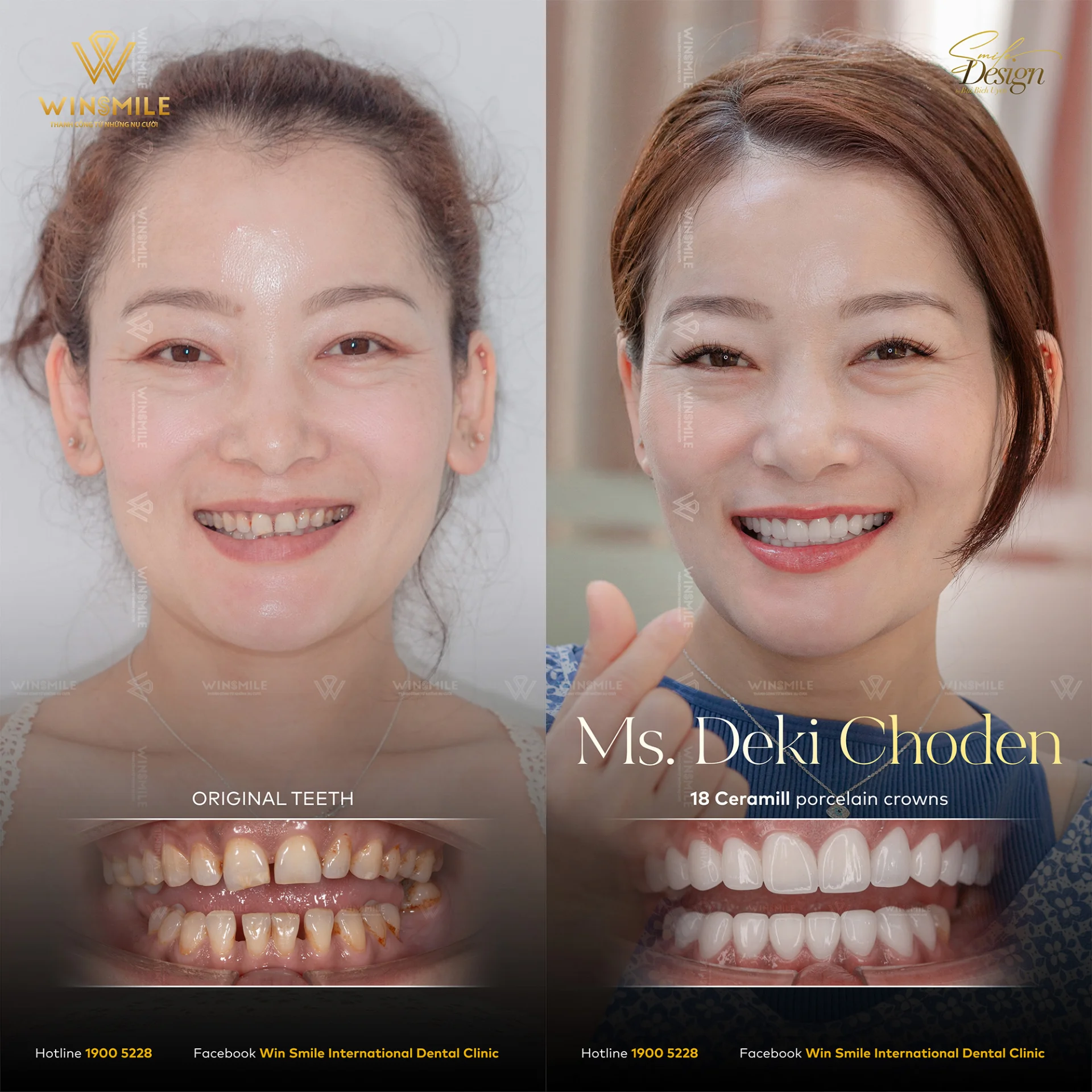Before and after smile transformation with porcelain restorations
