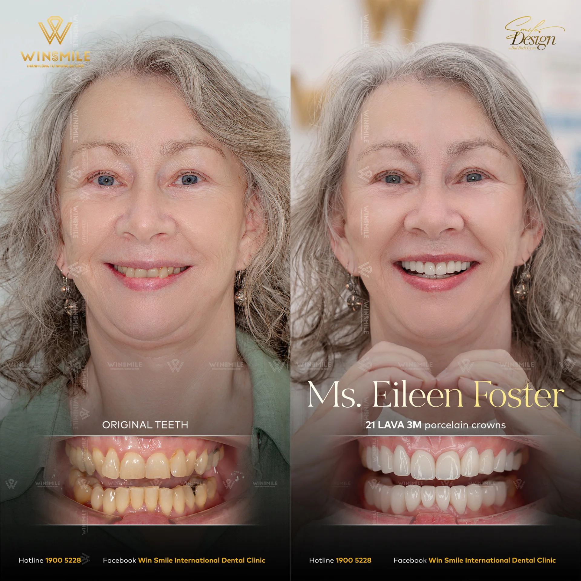 Before and after smile transformation with porcelain restorations