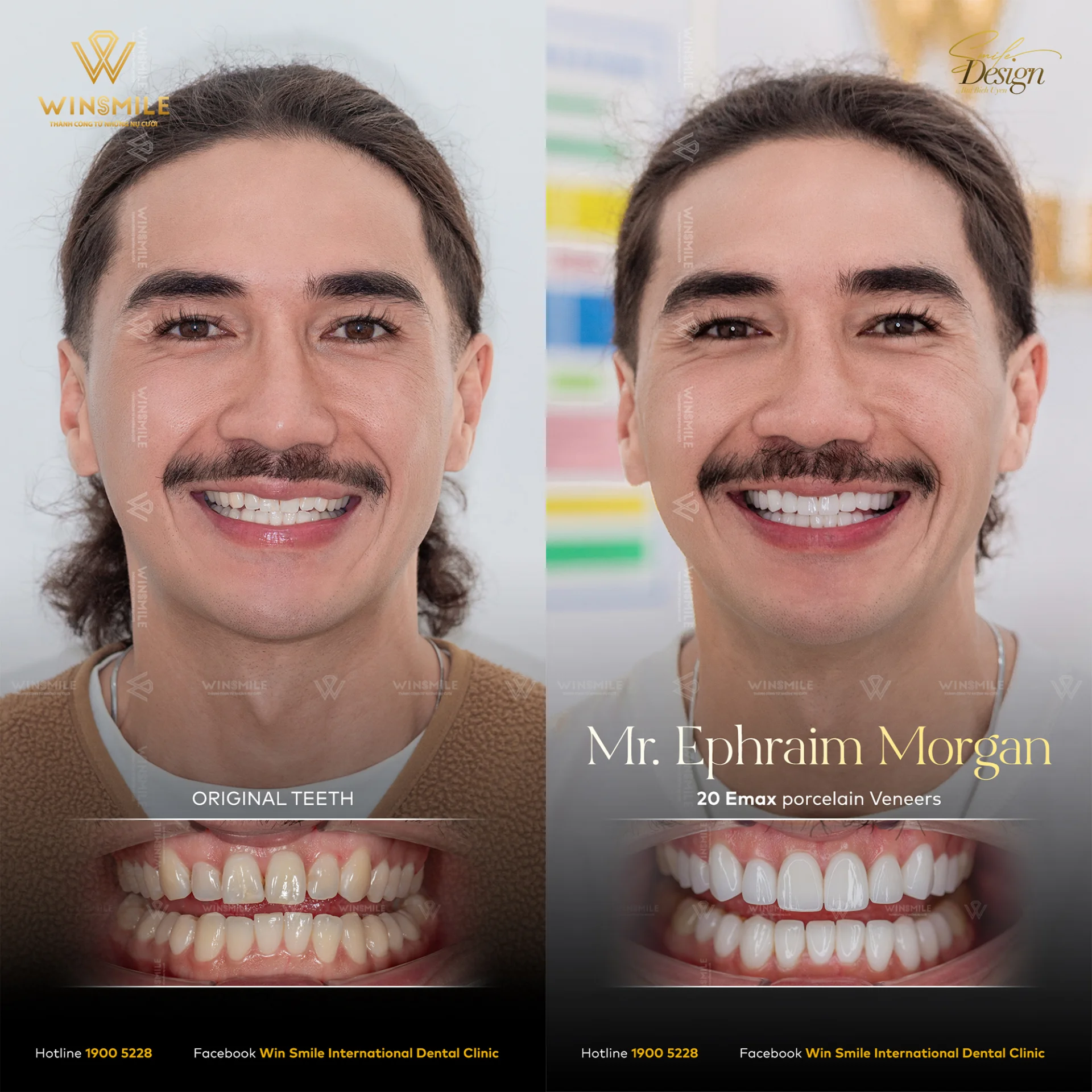 Before and after smile transformation with porcelain veneers