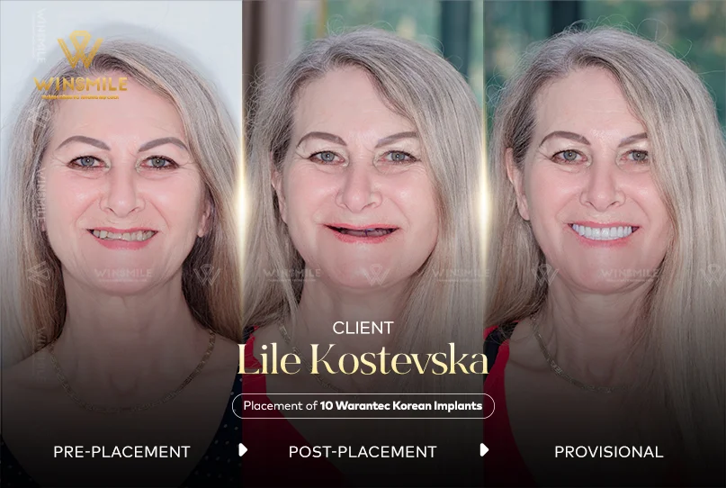 Ms. Lile reclaiming her youthful smile alongside Dr. Dinh Dinh Duc