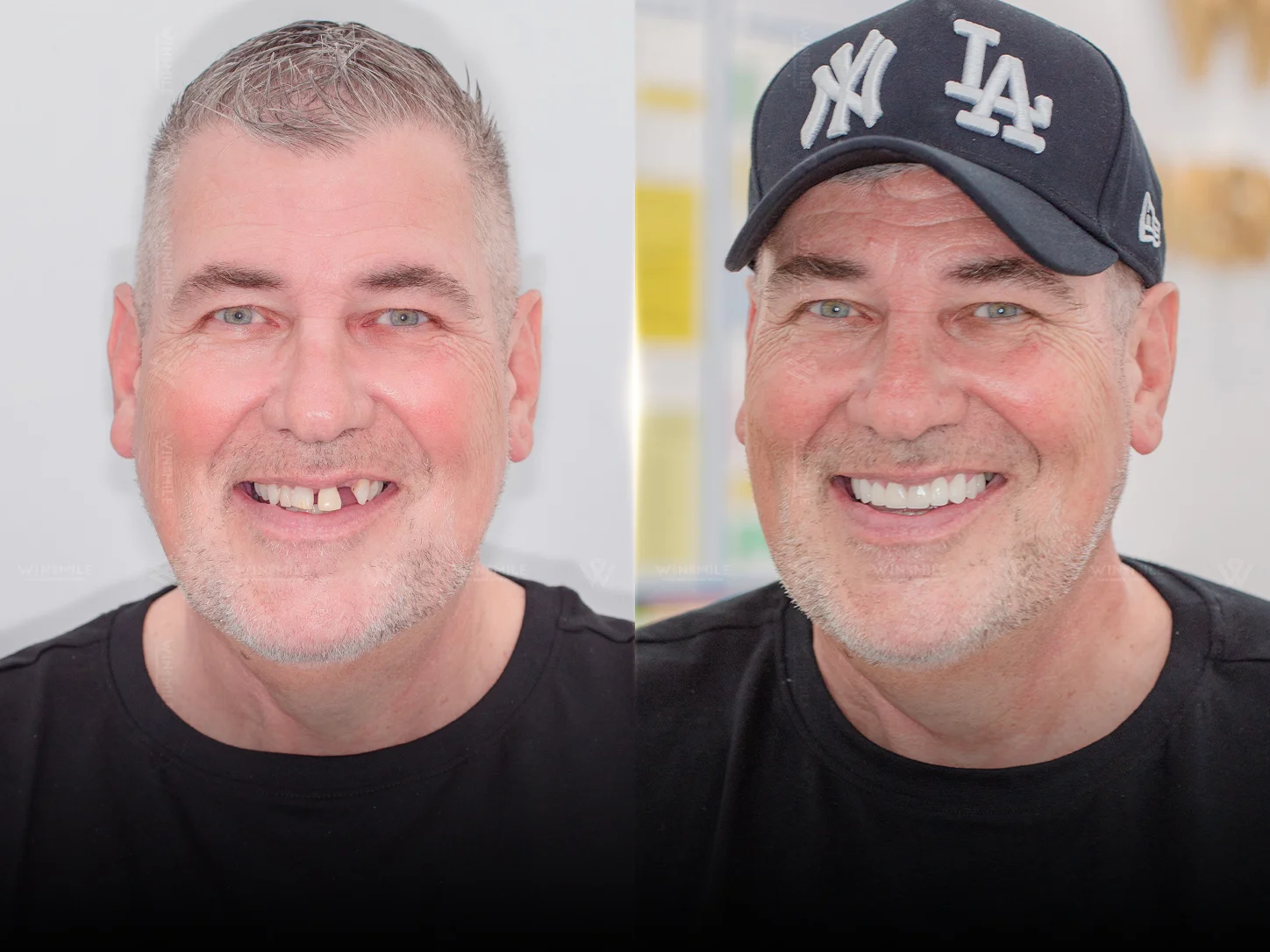 Implant restoration