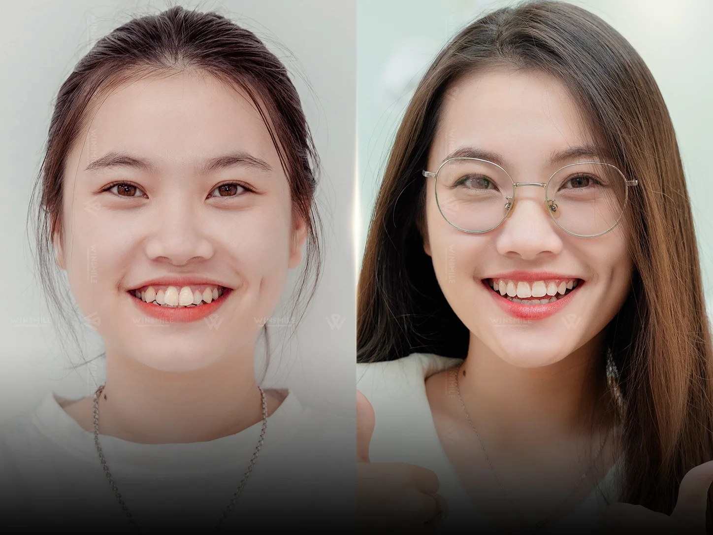 Orthodontic transformation