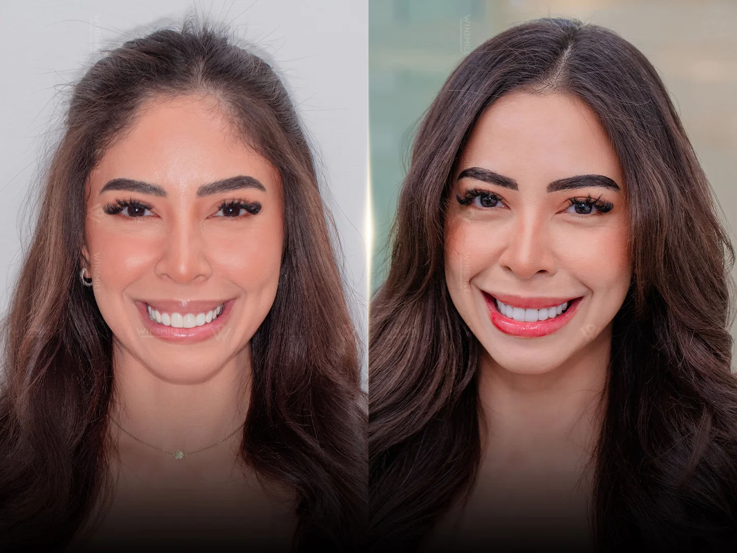 Porcelain smile design