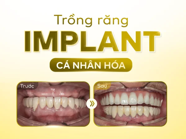 Chi phí Implant thay đổi bởi những yếu tố nào?