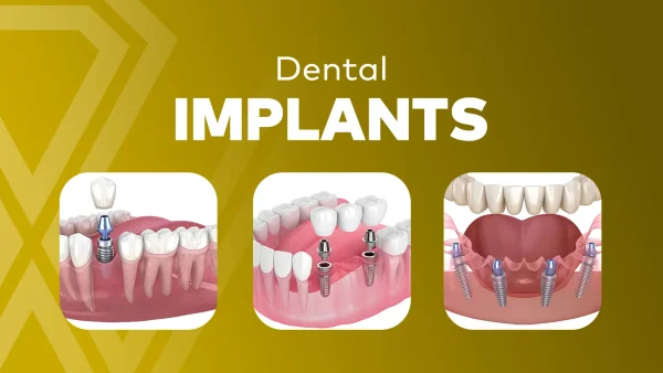 Dental Implants