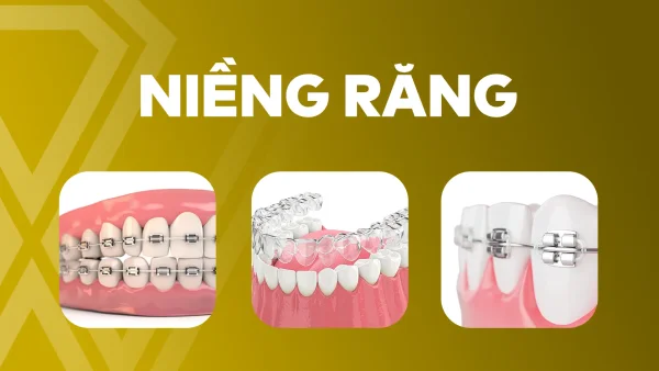 Niềng răng