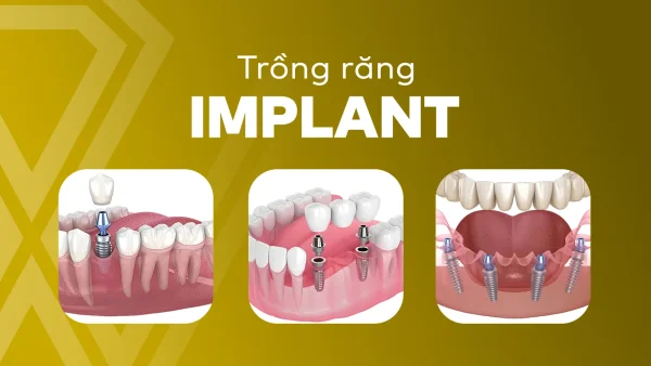 Trồng răng Implant