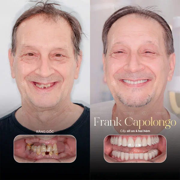 Full-mouth Implant Rehabilitation