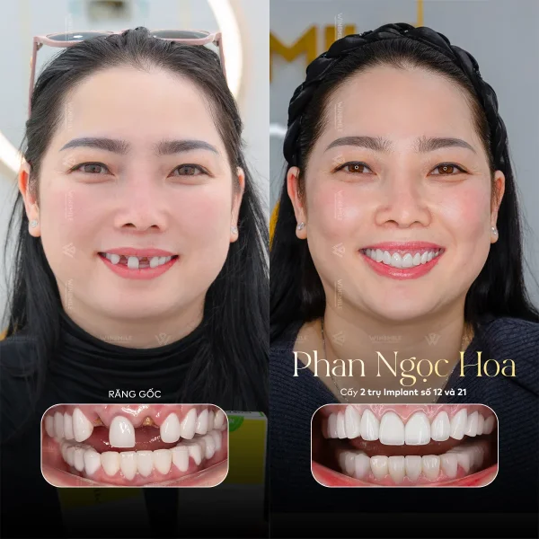 Multiple-tooth Implants