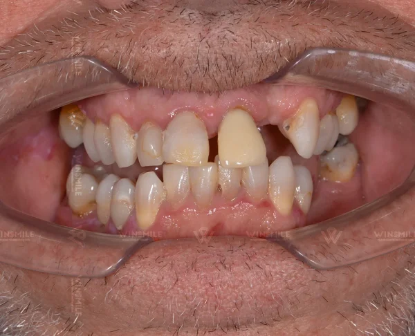 Several missing teeth