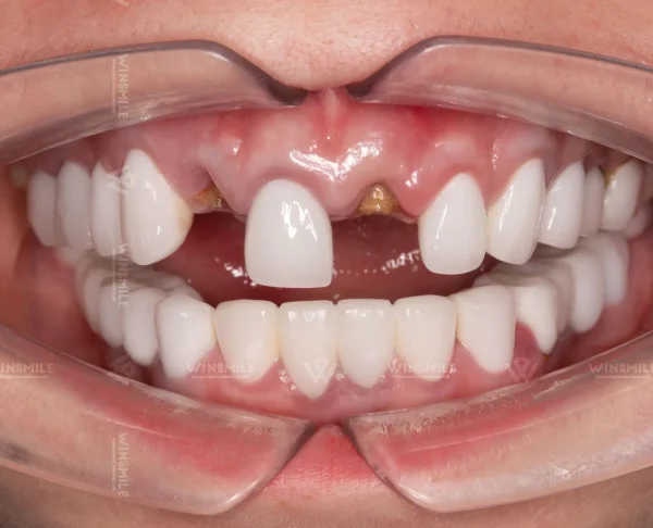 Anterior tooth replacement