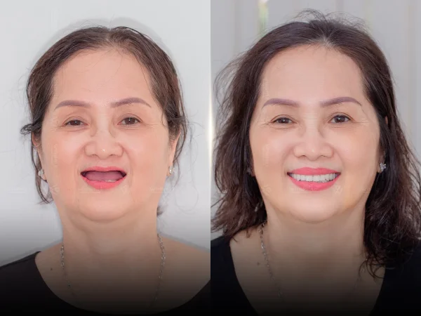 Full-arch tooth loss