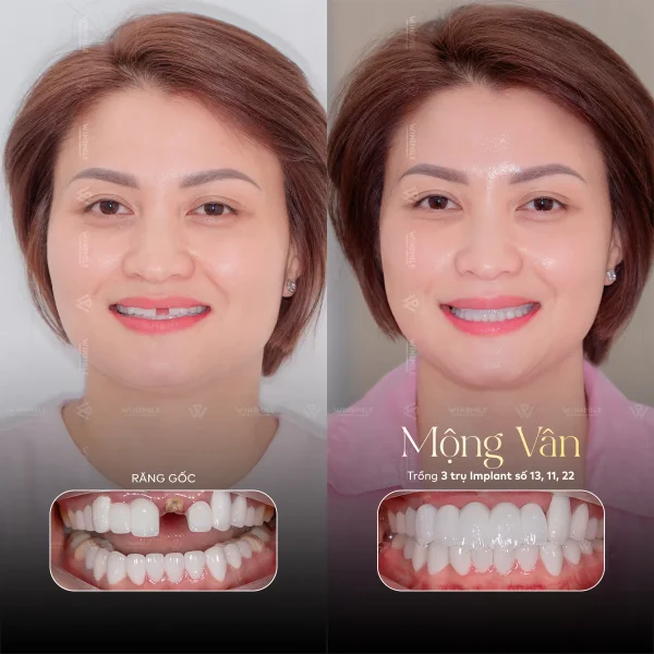 Single-tooth Implant