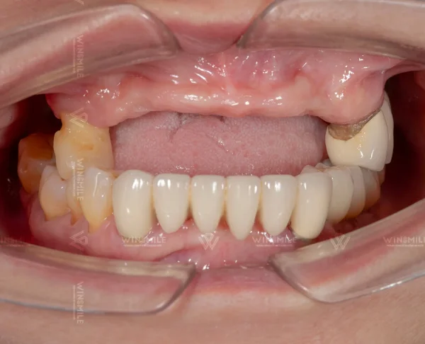 Full-arch tooth loss