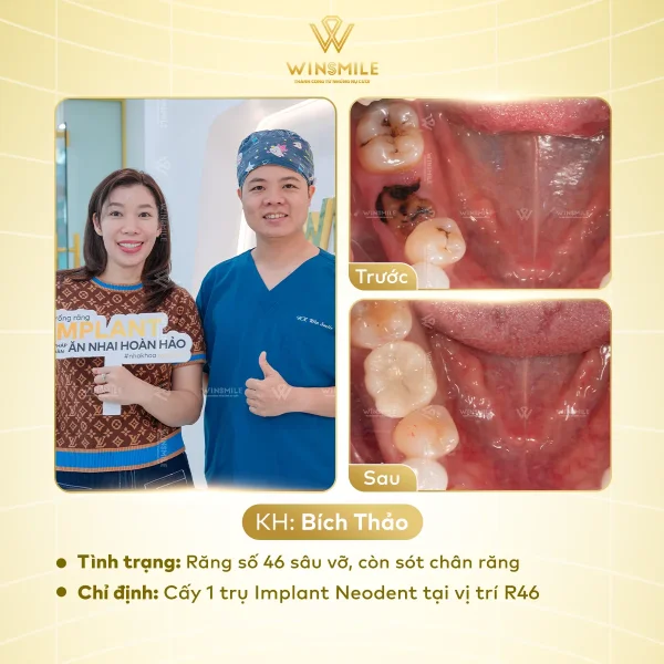 Dental decay & fillings
