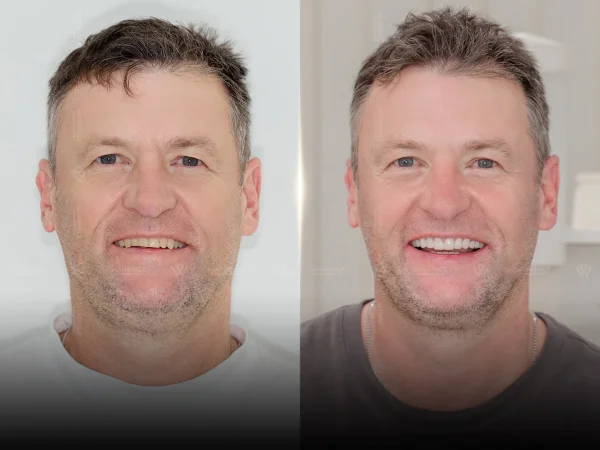Shade & tooth-form improvement