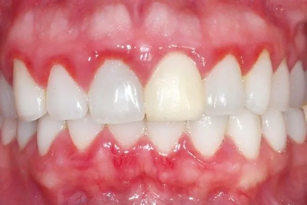 Gum & periodontal disease