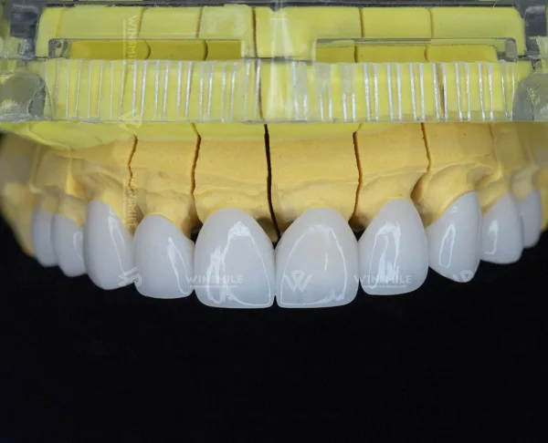 Understanding Premium Ceramics for Crowns & Veneers