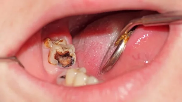 Pulp disease & root canal care