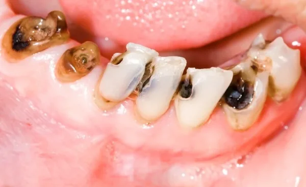 Dental decay & fillings