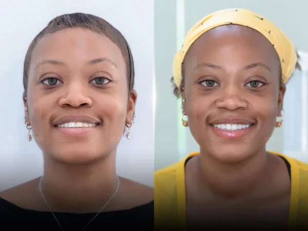 Personalised smile design